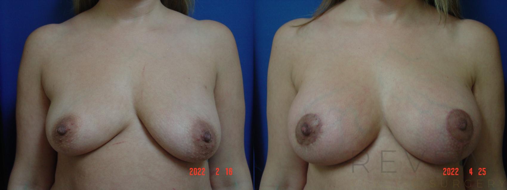 Before & After Breast Augmentation Case 633 Front View in San Jose, CA