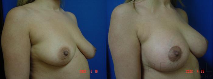 Before & After Breast Augmentation Case 633 Left Side View in San Jose, CA