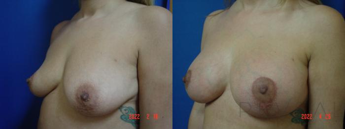 Before & After Breast Augmentation Case 633 Right Side View in San Jose, CA