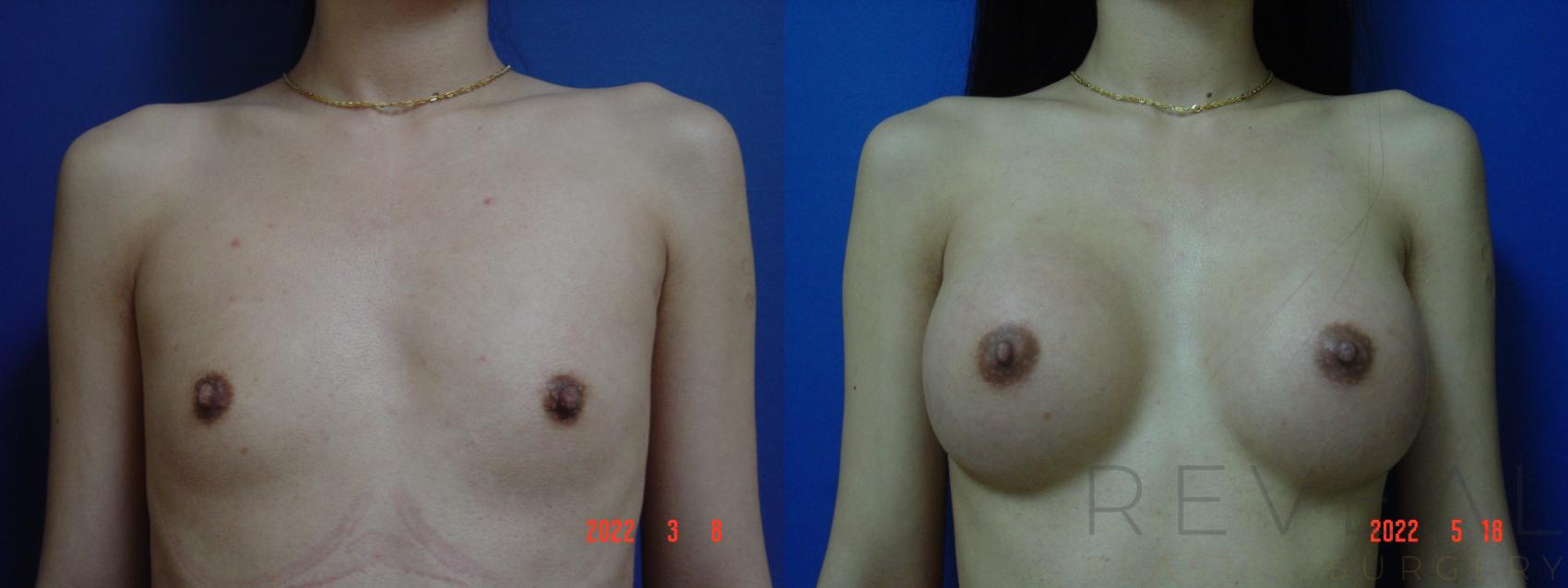 Before & After Breast Augmentation Case 635 Front View in San Jose, CA