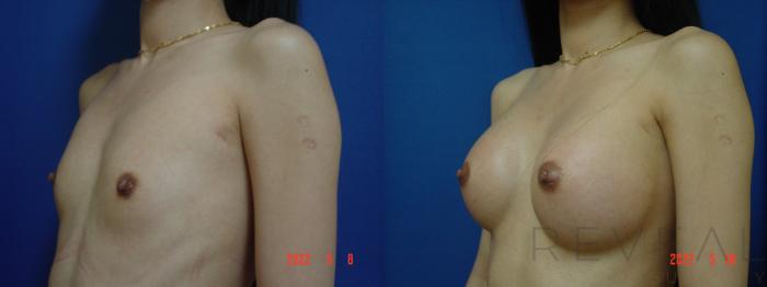 Before & After Breast Augmentation Case 635 Left Side View in San Jose, CA