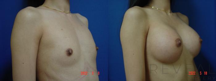 Before & After Breast Augmentation Case 635 Right Side View in San Jose, CA