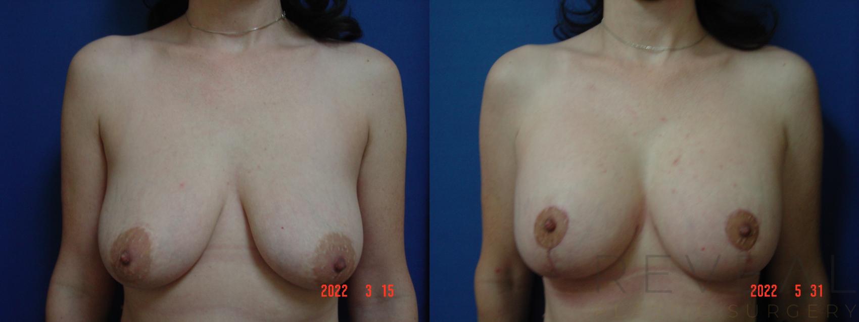Before & After Breast Augmentation Case 637 Front View in San Jose, CA