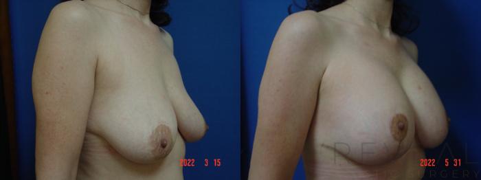 Before & After Breast Augmentation Case 637 Left Side View in San Jose, CA