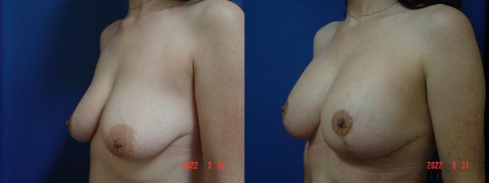 Before & After Breast Augmentation Case 637 Right Side View in San Jose, CA