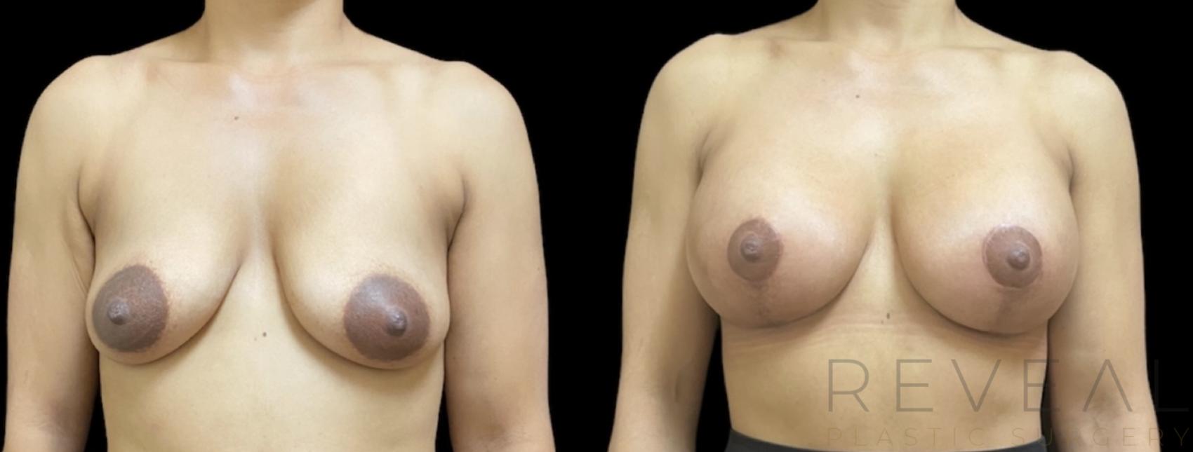 Before & After Breast Augmentation Case 640 Front View in San Jose, CA