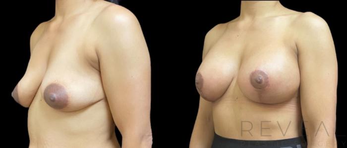 Before & After Breast Augmentation Case 640 Right Oblique View in San Jose, CA