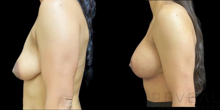 Before & After Breast Augmentation Case 640 Right Side View in San Jose, CA