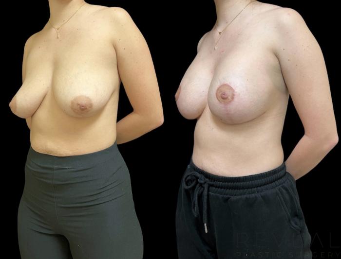 Before & After Breast Augmentation Case 645 Right Side View in San Jose, CA
