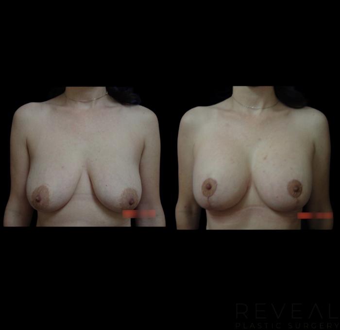 Before & After Breast Lift Case 651 Front View in San Jose, CA