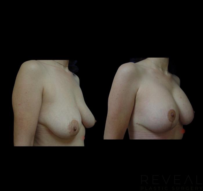 Before & After Breast Lift Case 651 Left Side View in San Jose, CA