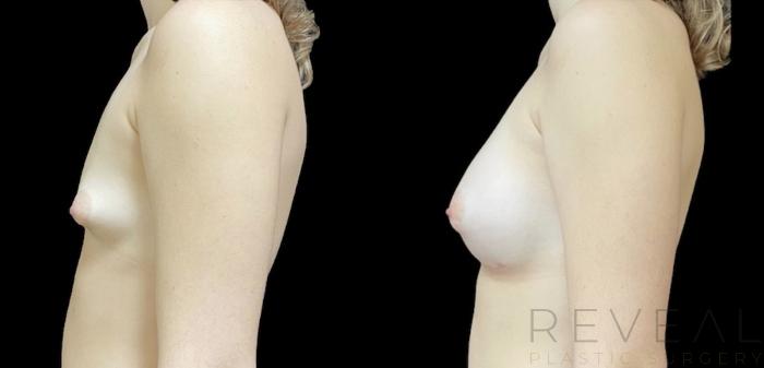Before & After Breast Augmentation Case 655 Right Oblique View in San Jose, CA
