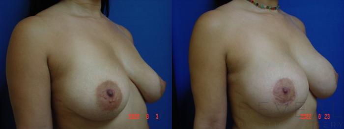 Before & After Breast Augmentation Case 664 Left Side View in San Jose, CA