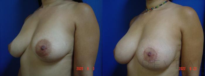 Before & After Breast Augmentation Case 664 Right Side View in San Jose, CA