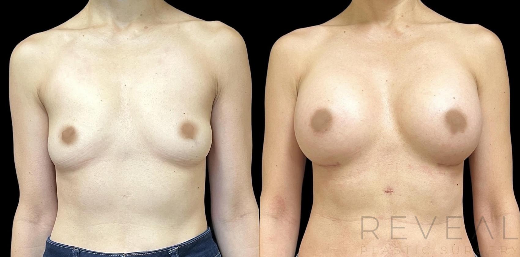 Before & After Breast Augmentation Case 666 Front View in San Jose, CA