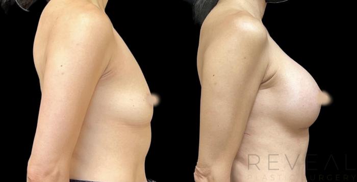 Before & After Breast Augmentation Case 666 Left Oblique View in San Jose, CA