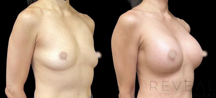 Before & After Breast Augmentation Case 666 Left Side View in San Jose, CA