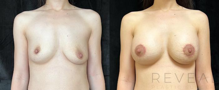 Before & After Breast Augmentation Case 674 Front View in San Jose, CA