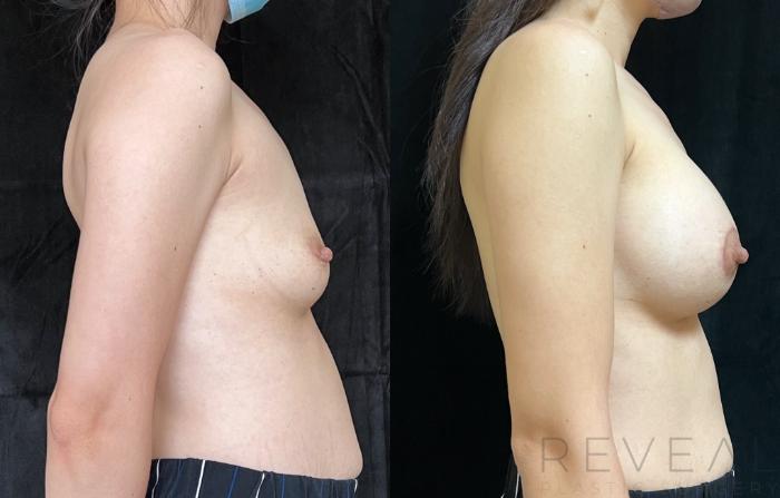 Before & After Breast Augmentation Case 674 Left Oblique View in San Jose, CA