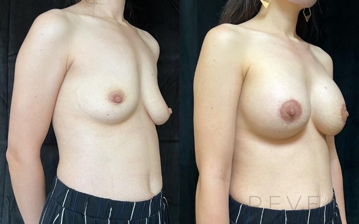 Before & After Breast Augmentation Case 674 Left Side View in San Jose, CA