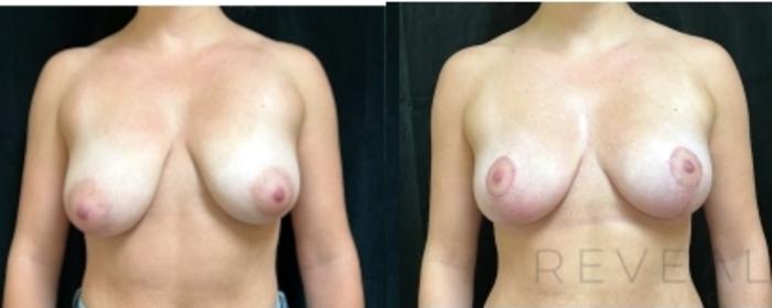Before & After Breast Augmentation Case 675 Front View in San Jose, CA