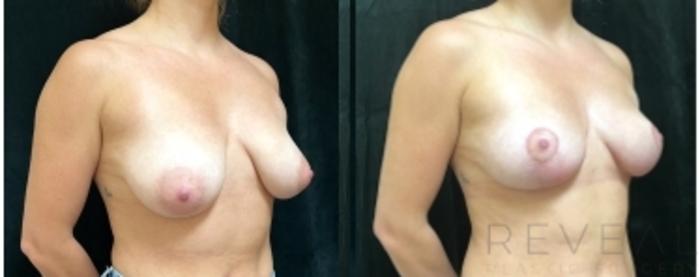 Before & After Breast Augmentation Case 675 Left Oblique View in San Jose, CA