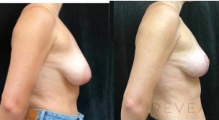 Before & After Breast Augmentation Case 675 Left Side View in San Jose, CA