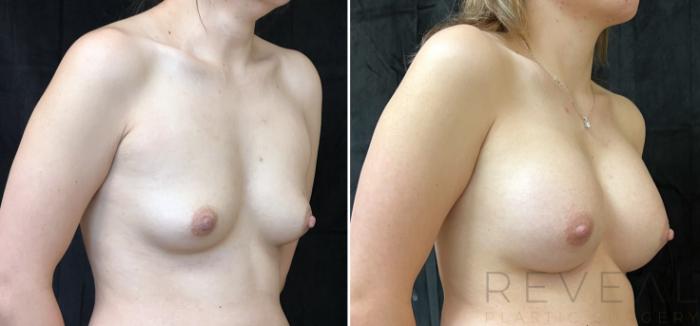 Before & After Breast Augmentation Case 678 Left Side View in San Jose, CA