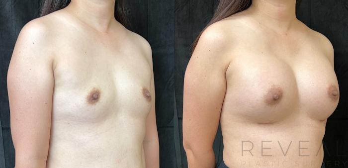 Before & After Breast Augmentation Case 679 Left Side View in San Jose, CA