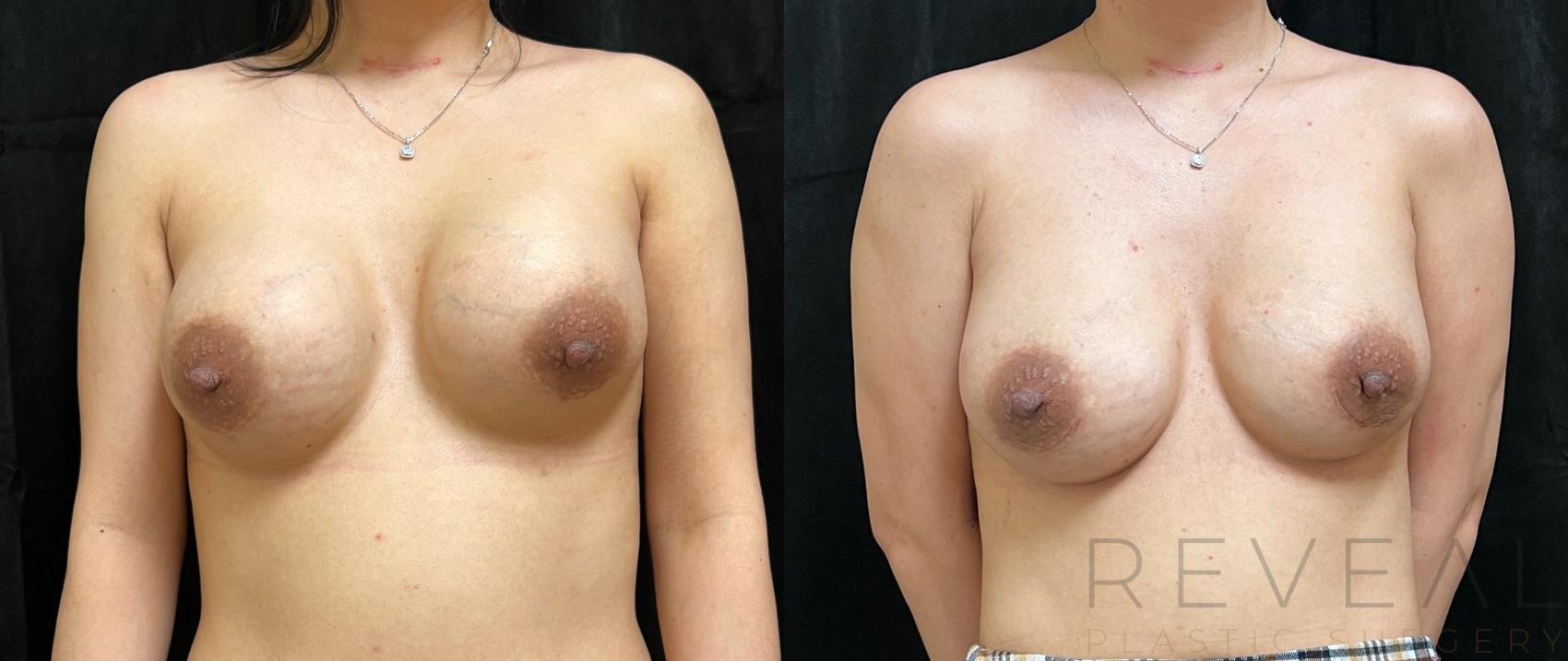 Before & After Breast Augmentation Case 680 Front View in San Jose, CA