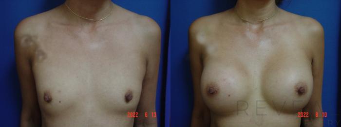 Before & After Breast Augmentation Case 682 Front View in San Jose, CA