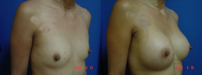 Before & After Breast Augmentation Case 682 Left Side View in San Jose, CA