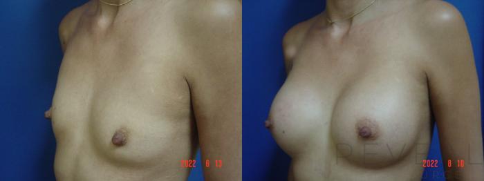 Before & After Breast Augmentation Case 682 Right Side View in San Jose, CA