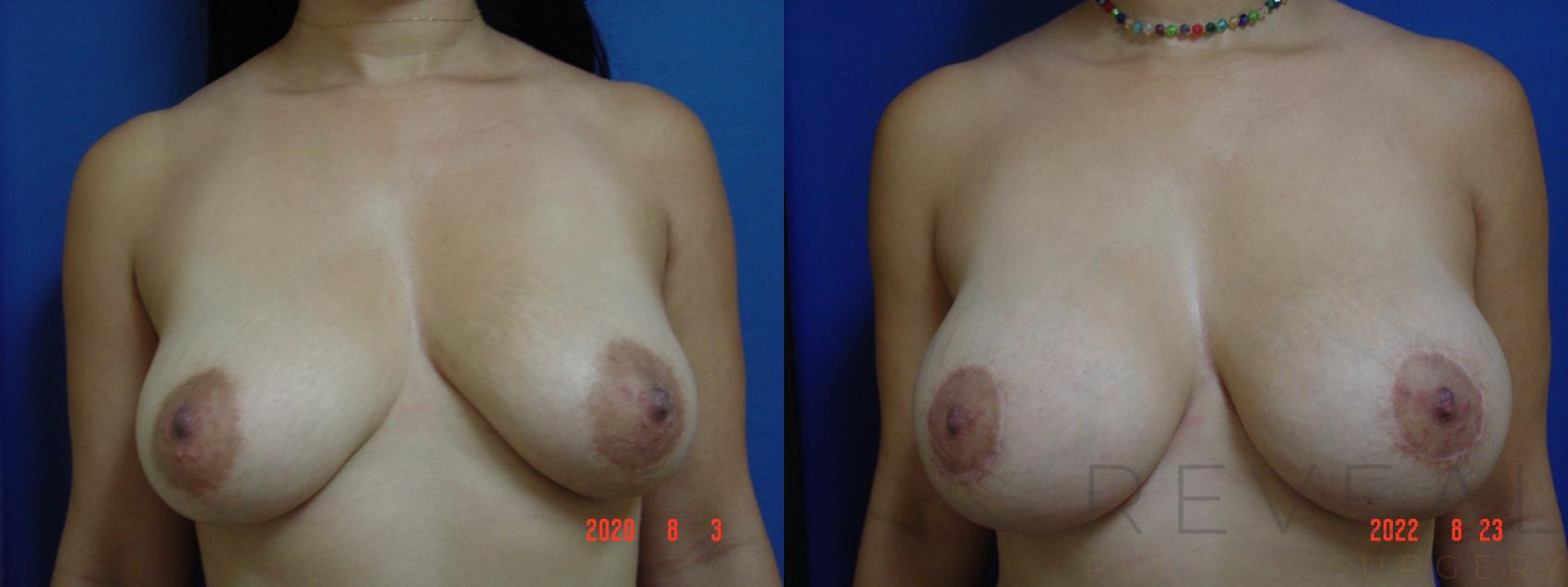 Before & After Breast Augmentation Case 684 Front View in San Jose, CA
