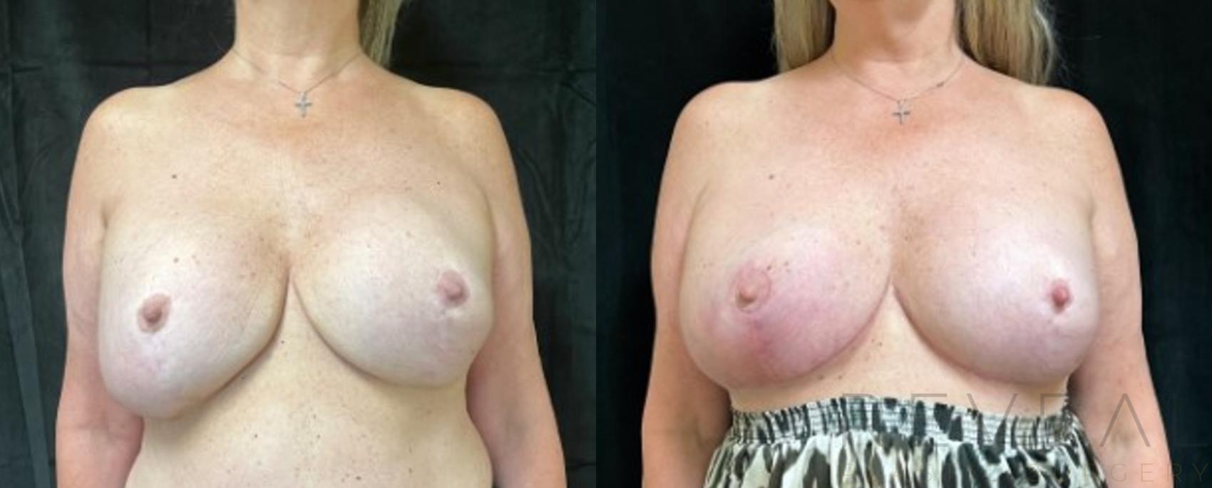 Before & After Breast Augmentation Case 685 Front View in San Jose, CA