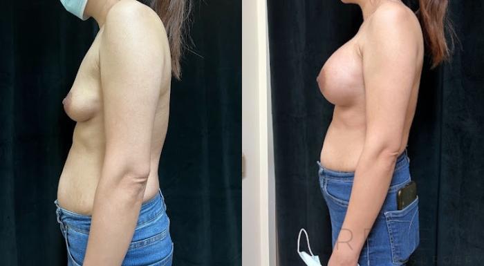 Before & After Breast Augmentation Case 691 Left Side View in San Jose, CA