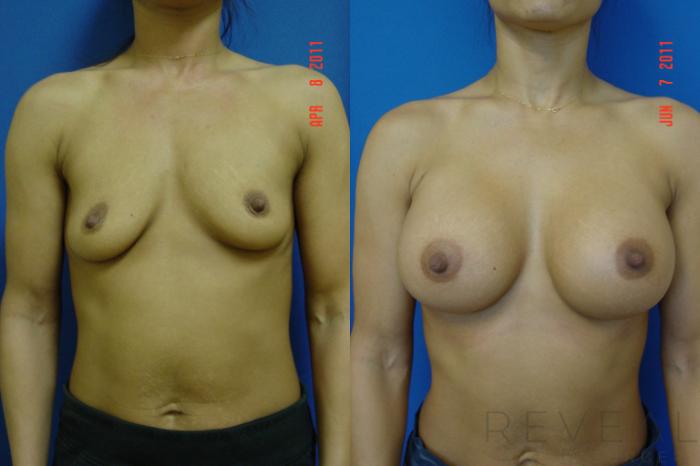 Before & After Breast Augmentation Case 70 View #1 View in San Jose, CA
