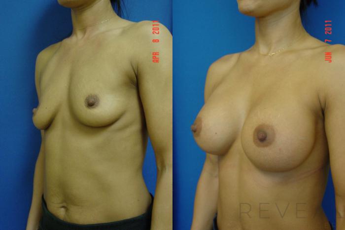 Before & After Breast Augmentation Case 70 View #2 View in San Jose, CA