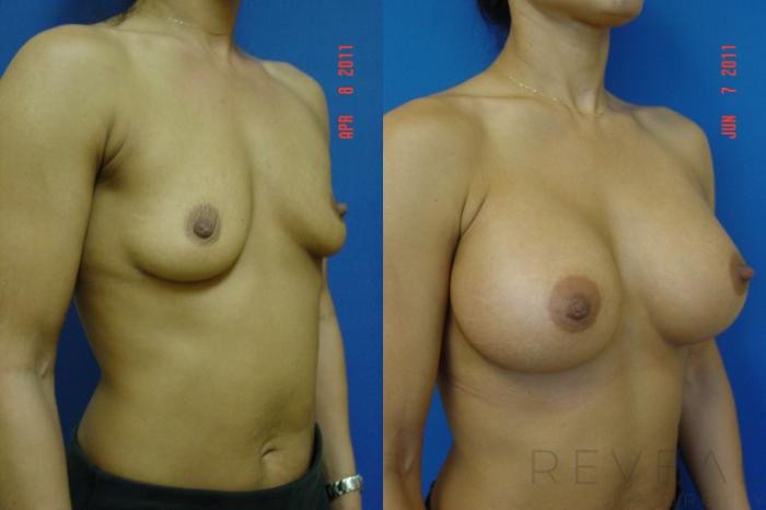 Before & After Breast Augmentation Case 70 View #3 View in San Jose, CA