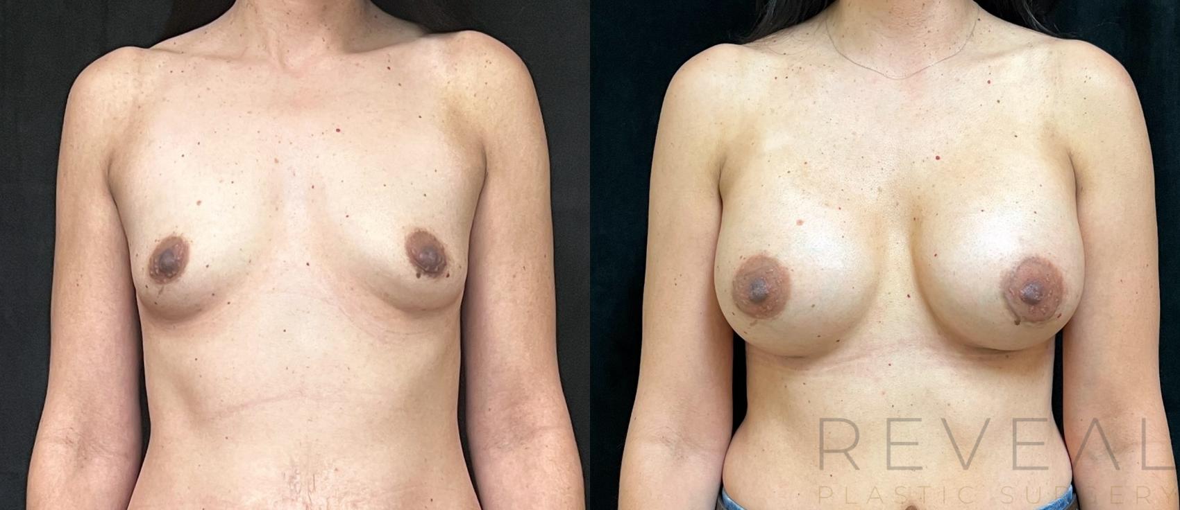 Before & After Breast Augmentation Case 700 Front View in San Jose, CA