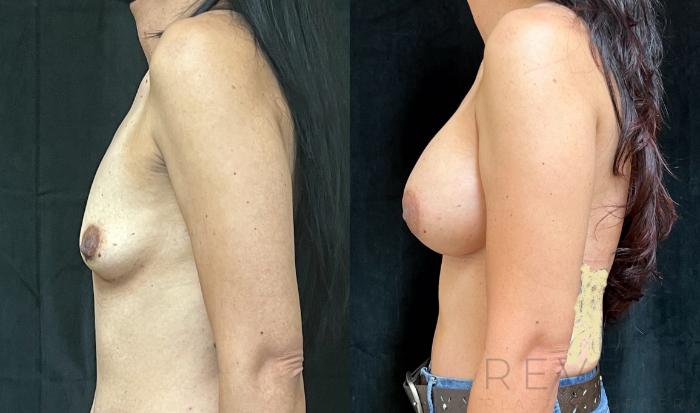Before & After Breast Augmentation Case 700 Left Side View in San Jose, CA