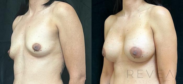 Before & After Breast Augmentation Case 700 Right Side View in San Jose, CA