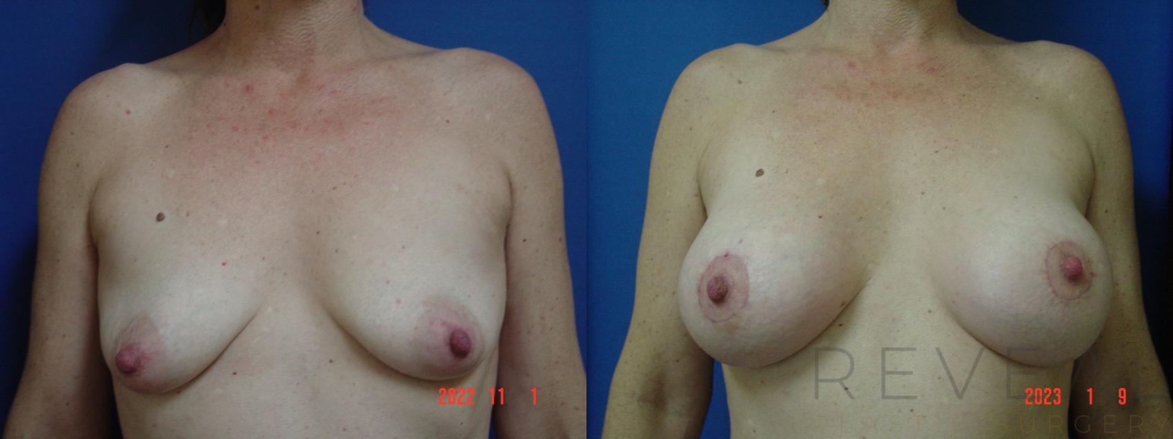 Before & After Breast Augmentation Case 704 Front View in San Jose, CA