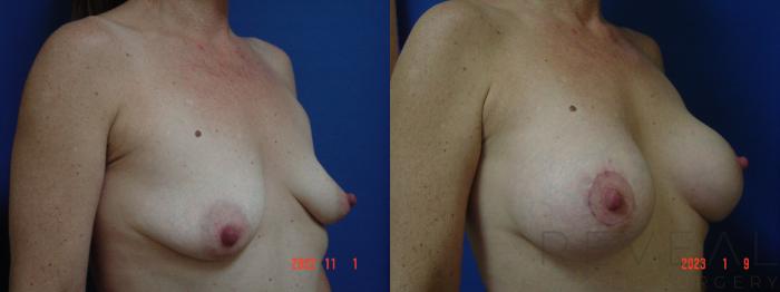 Before & After Breast Augmentation Case 704 Left Side View in San Jose, CA
