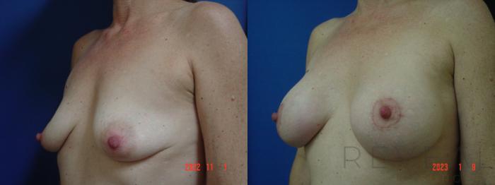 Before & After Breast Augmentation Case 704 Right Side View in San Jose, CA