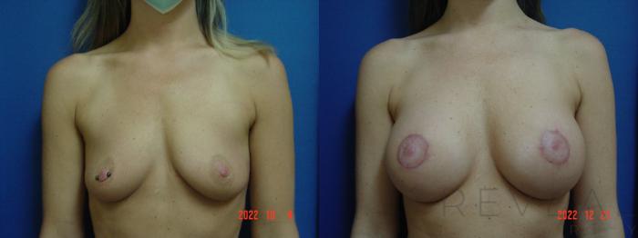 Before & After Breast Augmentation Case 705 Front View in San Jose, CA