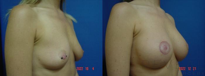 Before & After Breast Augmentation Case 705 Left Side View in San Jose, CA