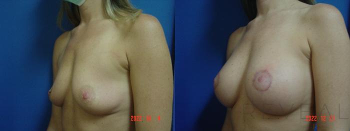 Before & After Breast Augmentation Case 705 Right Side View in San Jose, CA