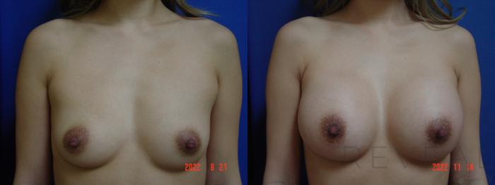 Before & After Breast Augmentation Case 706 Front View in San Jose, CA