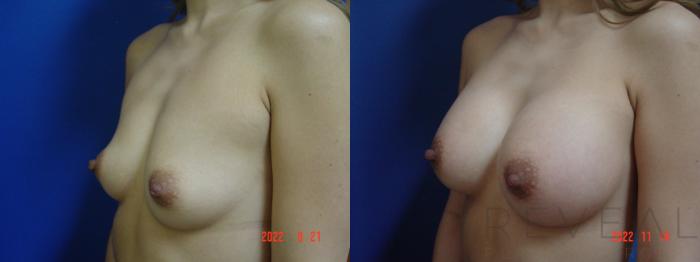 Before & After Breast Augmentation Case 706 Right Side View in San Jose, CA